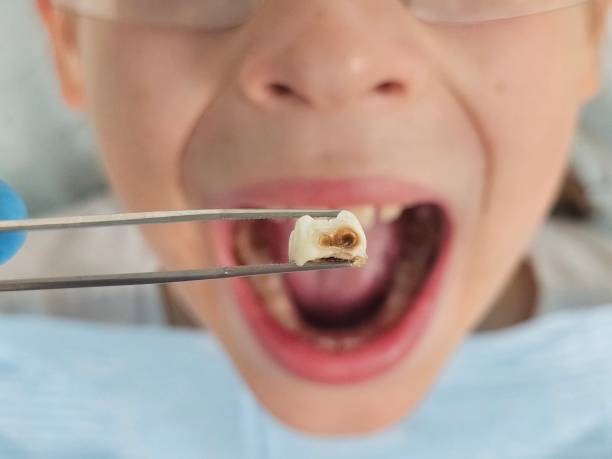 Best Cracked Tooth Emergency Dentist  in Brookville, OH